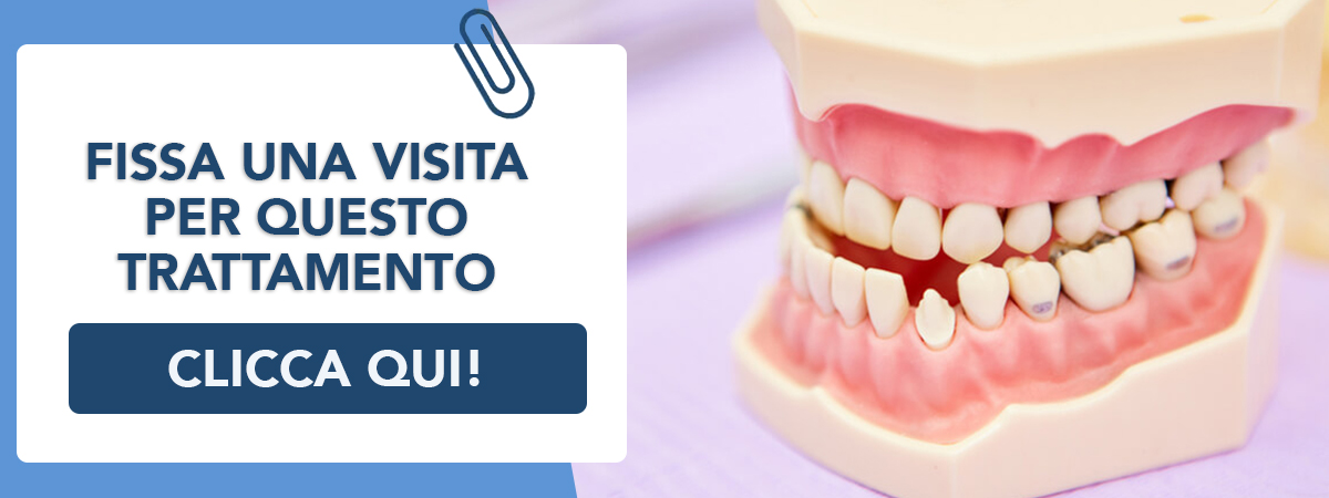 malocclusioni-dentali Formia e Frattamaggiore